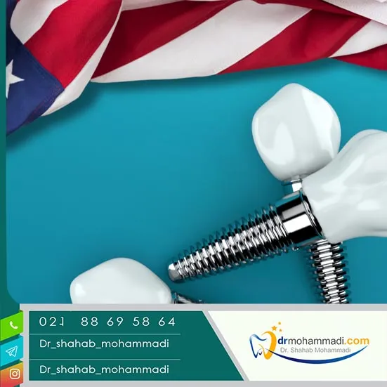 ایمپلنت آمریکایی بهتر است یا سوئیسی